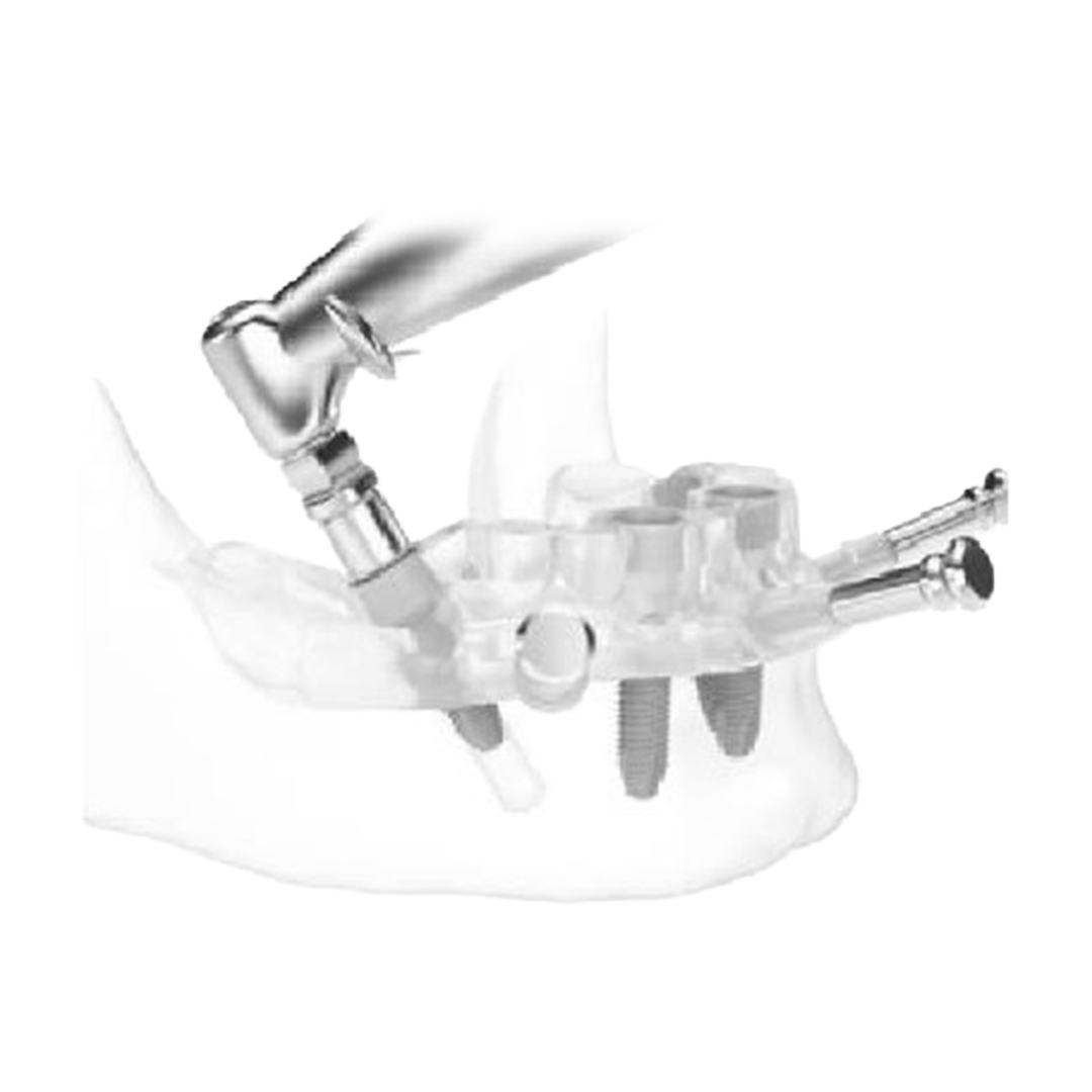 Guided Implant Technology